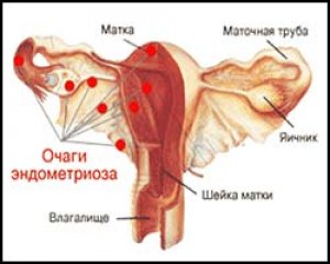 Эндометриоз. Лечение эндометриоза