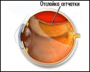 Ретинопатия, отслойка сетчатки, лечение отслойки сетчатки, отслойка сетчатки лечение, от отслойки сетчатки, ретинопатия лечение, лечение ретинопатии, лекарства от ретинопатии, от ретинопатии, частичная отслойка сетчатки, неполное отслоение сетчатки, отсло