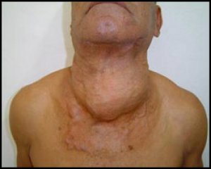 Аденома щитовидной железы. Лечение аденомы щитовидки