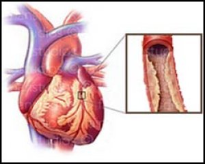 Коронарокардиосклероз, кардиосклероз, от кардиосклероза, лечение кардиосклероза, кардиосклероз атеросклеротический, кардиосклероз гипоксический, кардиосклероз диффузный, кардиосклероз заместительный, кардиосклероз интерстициальный, кардиосклероз ишемическ