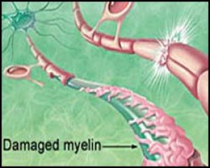 Рассеянный склероз, склероз рассеянный, лечение рассеянного склероза, рассеянный склероз лечение, от рассеянного склероза, склероз боковой амиотрофический, лечение склероза бокового амиотрофического, демиелинизация нервов, Шарко болезнь, лечение болезни Ш