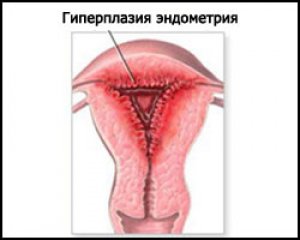 Гиперплазия эндометрия. Лечение гиперплазии эндометрия