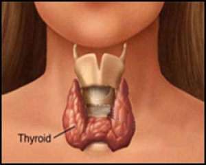 Гиперплазия щитовидной железы. Лечение гиперплазии щитовидки
